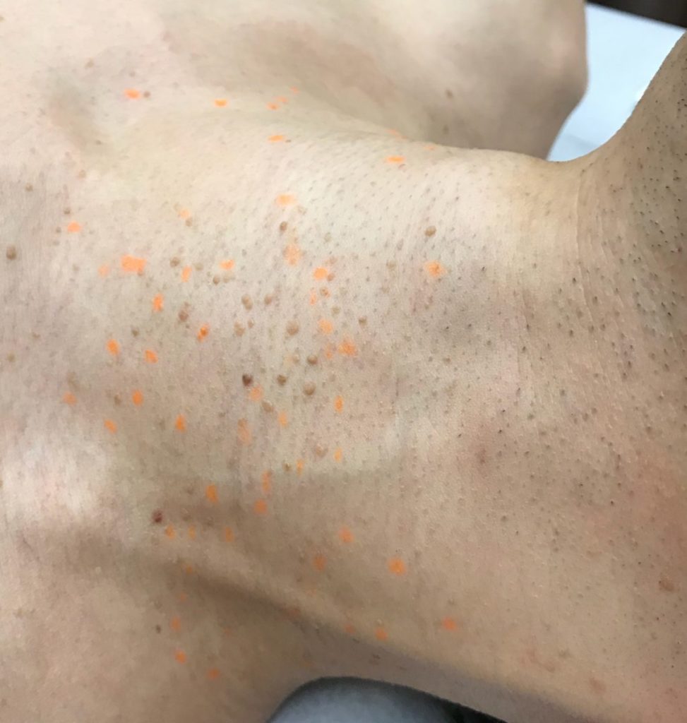 首イボ　ぽつぽつ　アクロコルドン