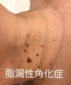 首イボ　脂漏性角化症