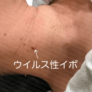 首イボ　ウイルス性