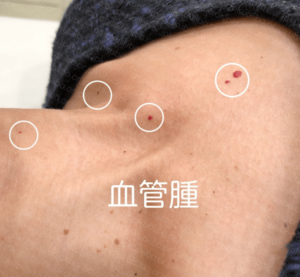 首イボ　血管腫