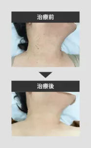 首イボ治療後の症例