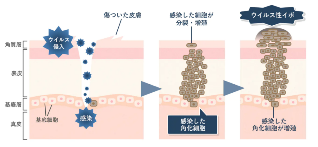 ウイルス性のイボの図解